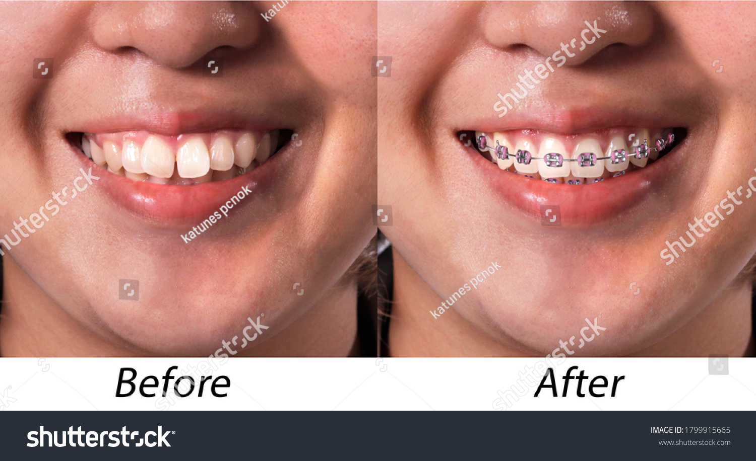 Braces