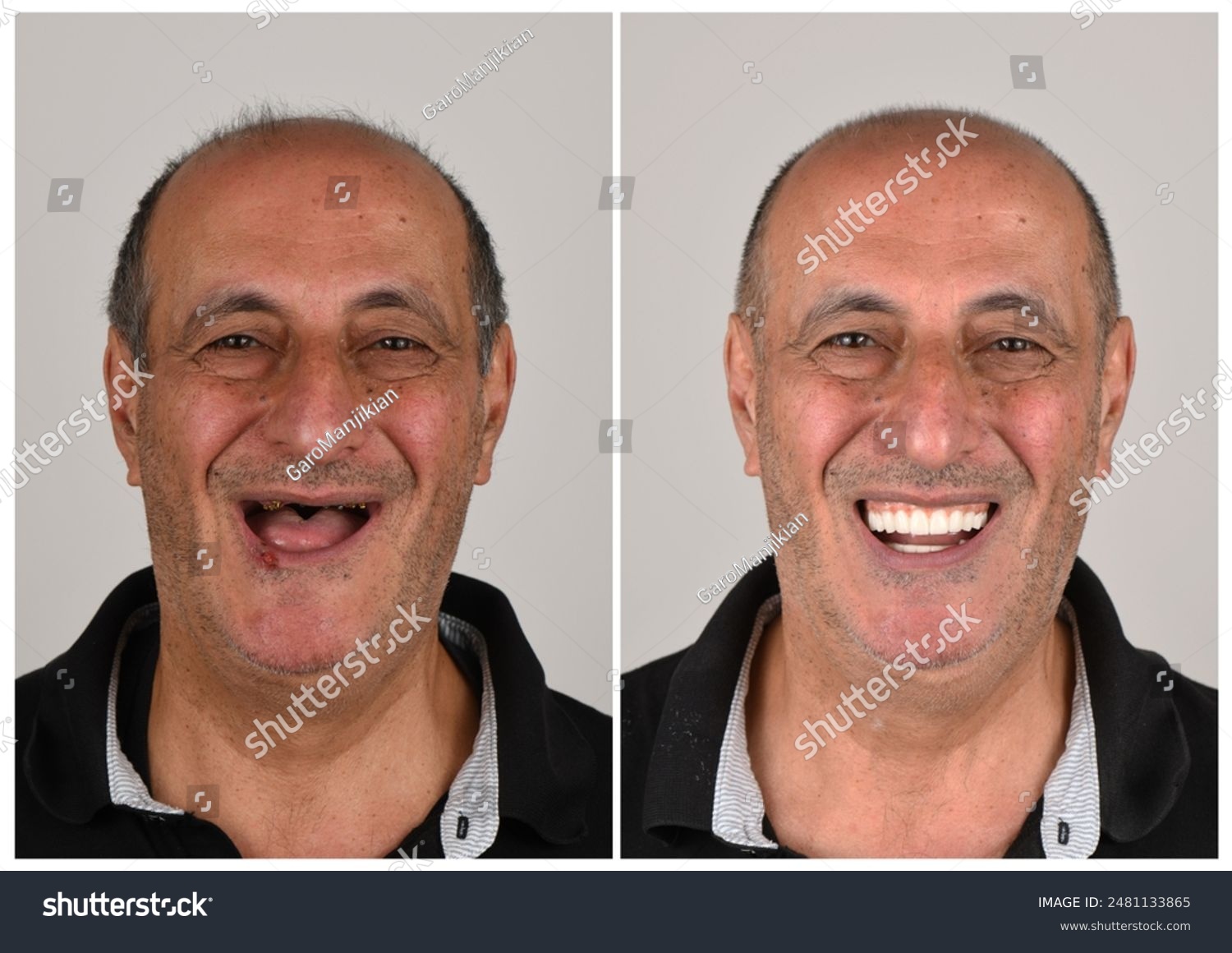 Dental Implants